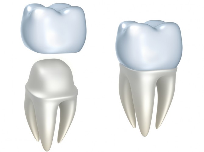 dental crowns mckinney dentist