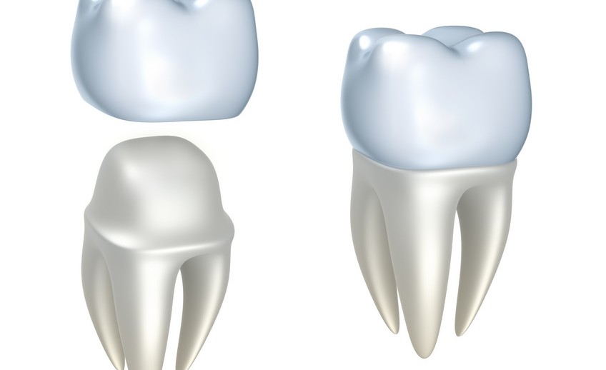 dental crowns mckinney dentist