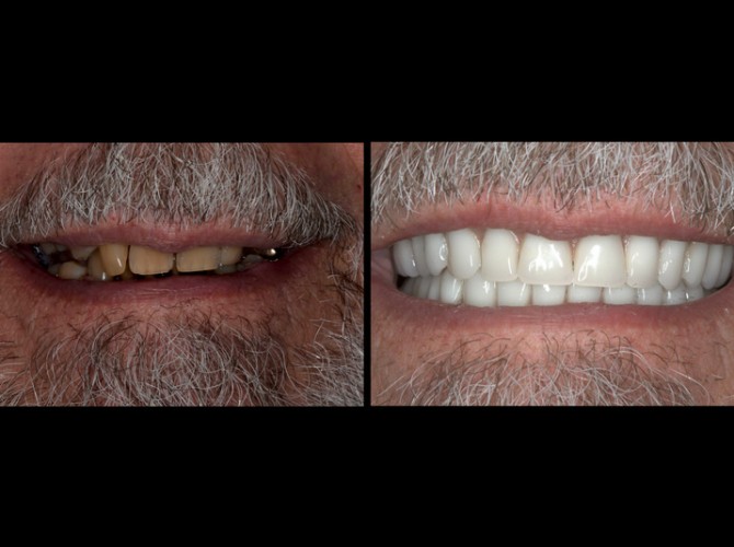 mckinney dentist dentures