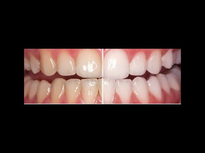 teeth whitening mckinney dentist