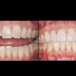 veneers mckinney dentist