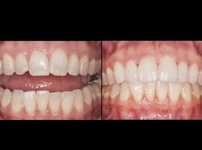 veneers mckinney dentist