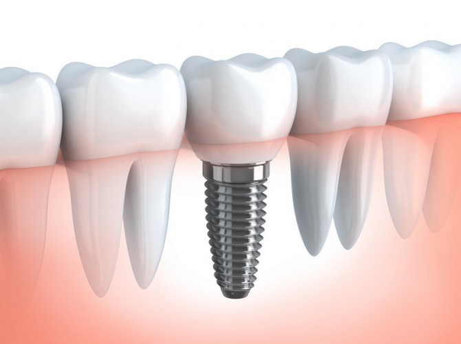 dental implant mckinney dentist