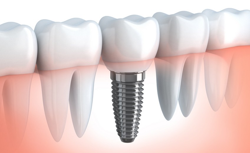 dental implant mckinney dentist