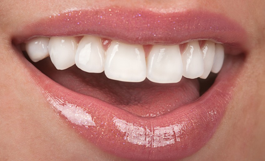 veneers mckinney dentist