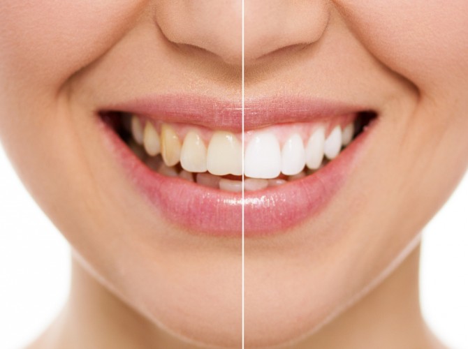 teeth whitening mckinney dentist