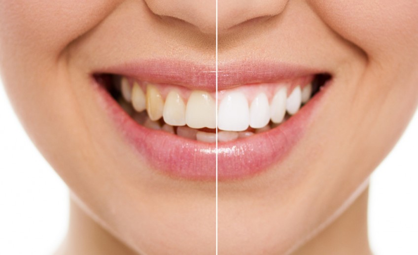 teeth whitening mckinney dentist