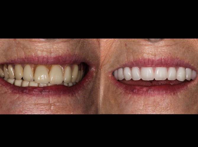 before after dentures mckinley dentist