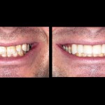 Veneers McKinney Dentist