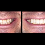 Veneers McKinney Dentist