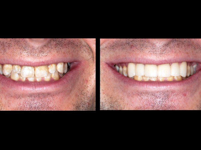 Veneers McKinney Dentist