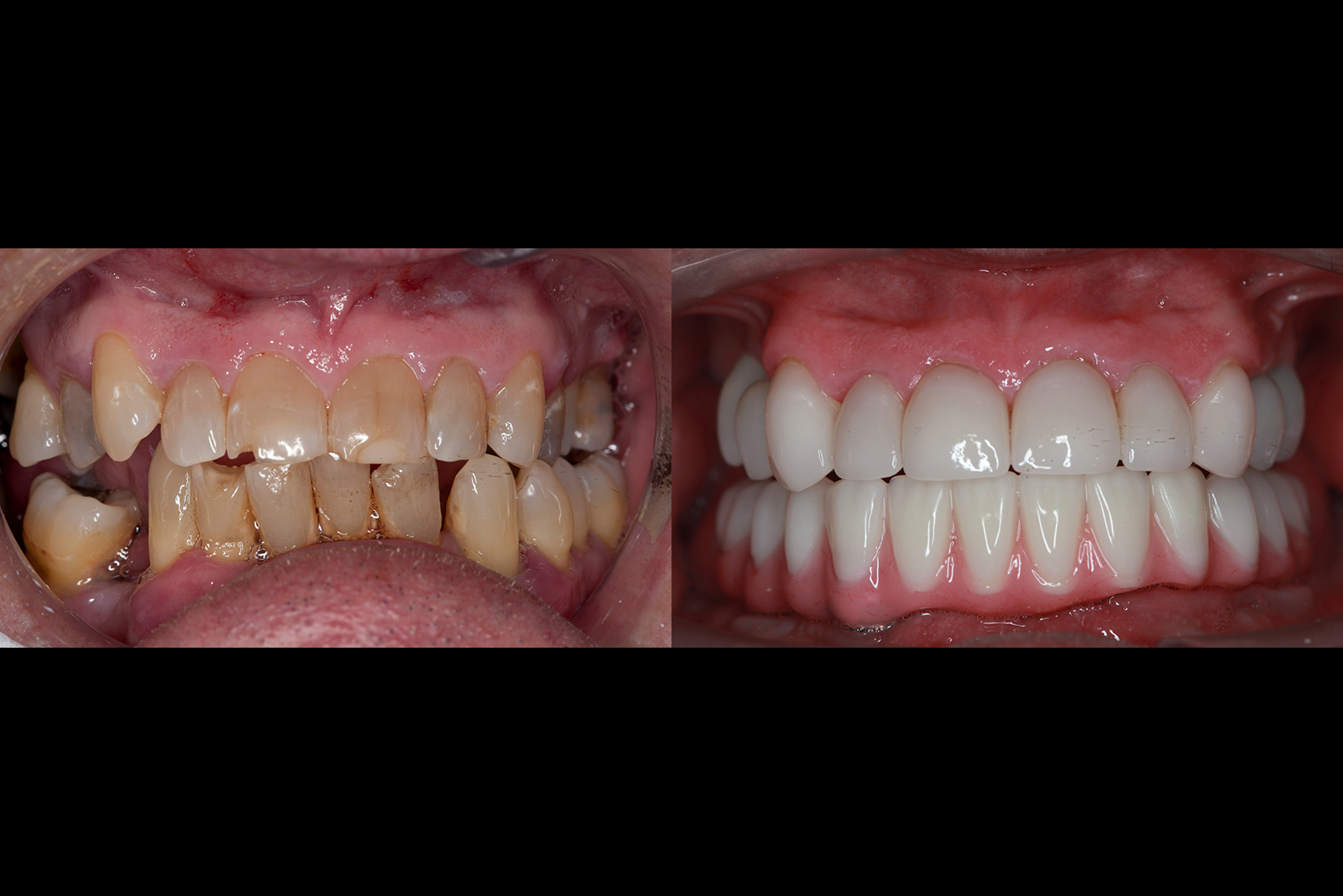 Implants Dentures McKinney Dentist