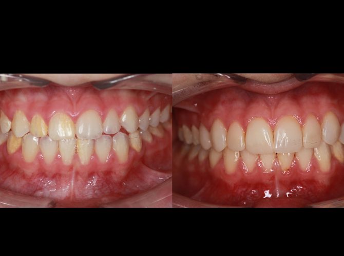 before after composite veneers